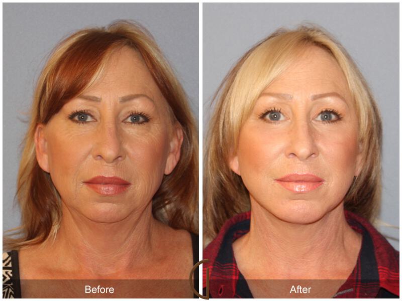 Facelift Forties Before & After Photo