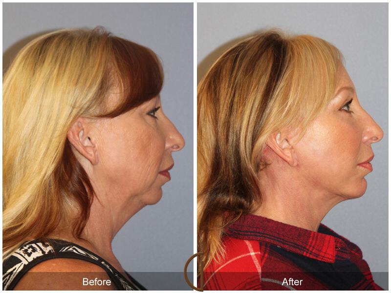 Facelift Forties Before & After Photo