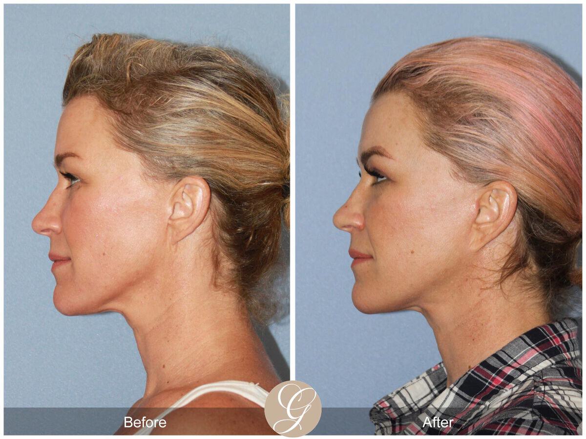 Facelift Forties Before & After Photo