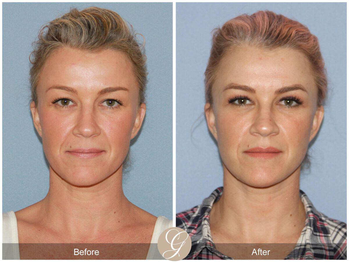 Facelift Forties Before & After Photo