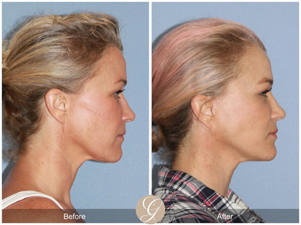 Facelift Forties Before & After Photo