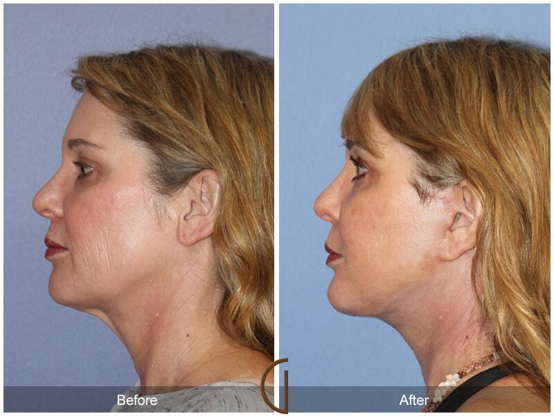 Facelift Forties Before & After Photo