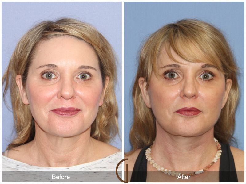 Facelift Forties Before & After Photo