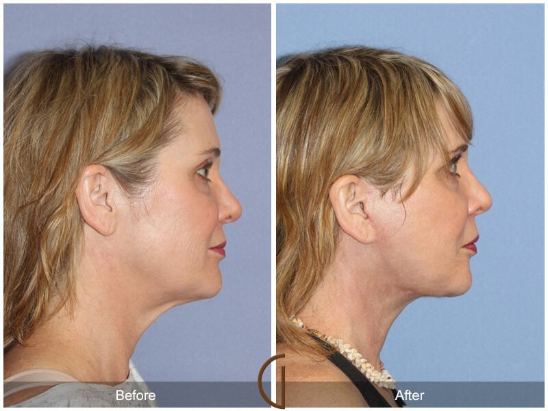 Facelift Forties Before & After Photo