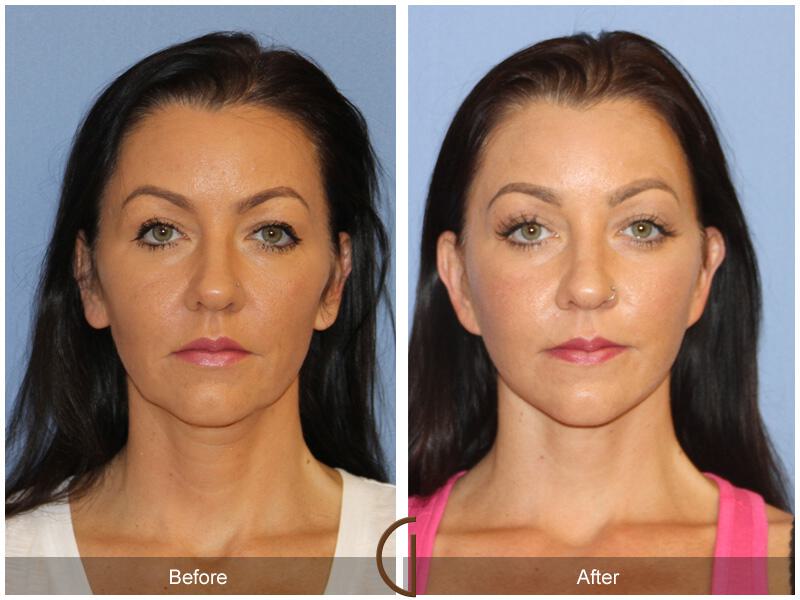 Facelift Forties Before & After Photo