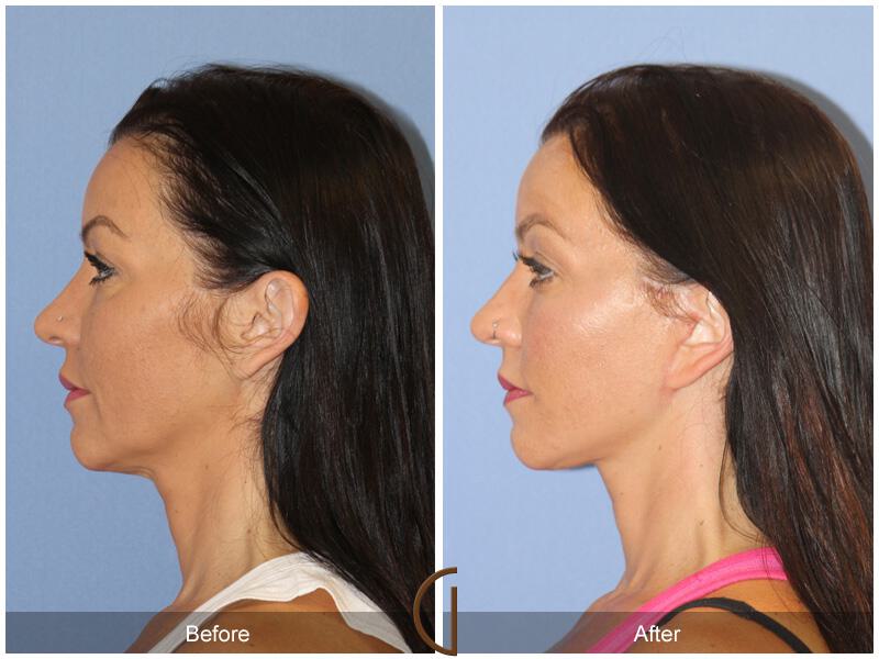 Facelift Forties Before & After Photo