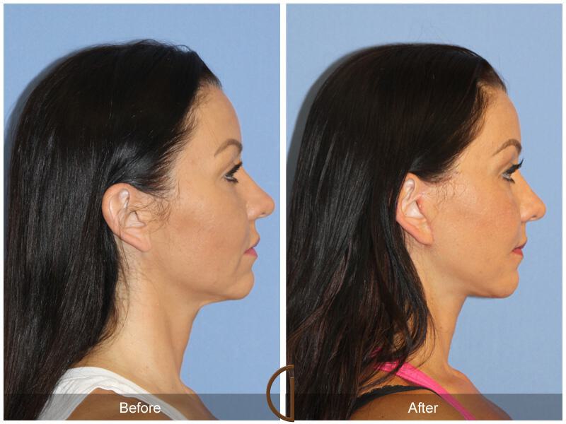 Facelift Forties Before & After Photo