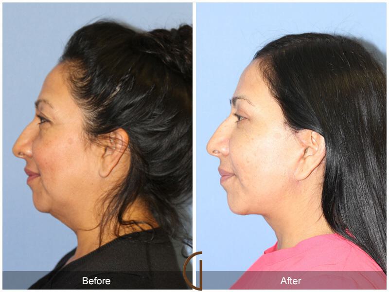 Facelift Forties Before & After Photo