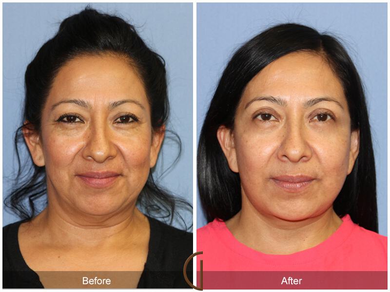 Facelift Forties Before & After Photo