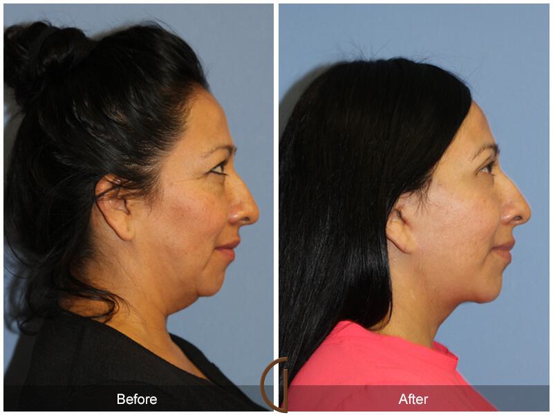 Facelift Forties Before & After Photo