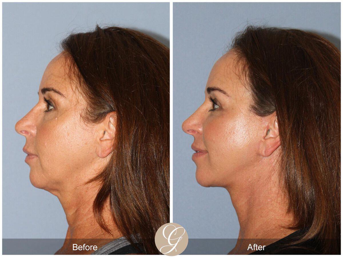 Facelift Forties Before & After Photo