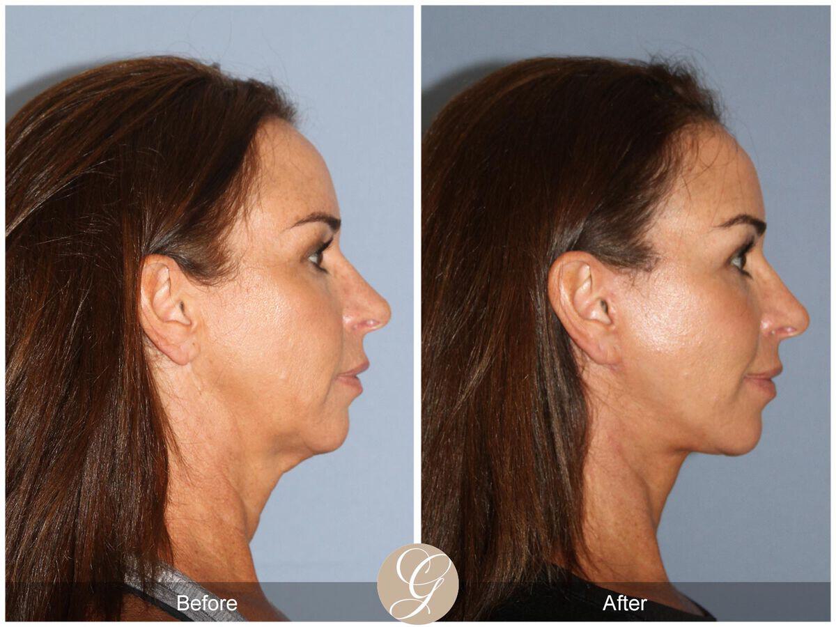 Facelift Forties Before & After Photo