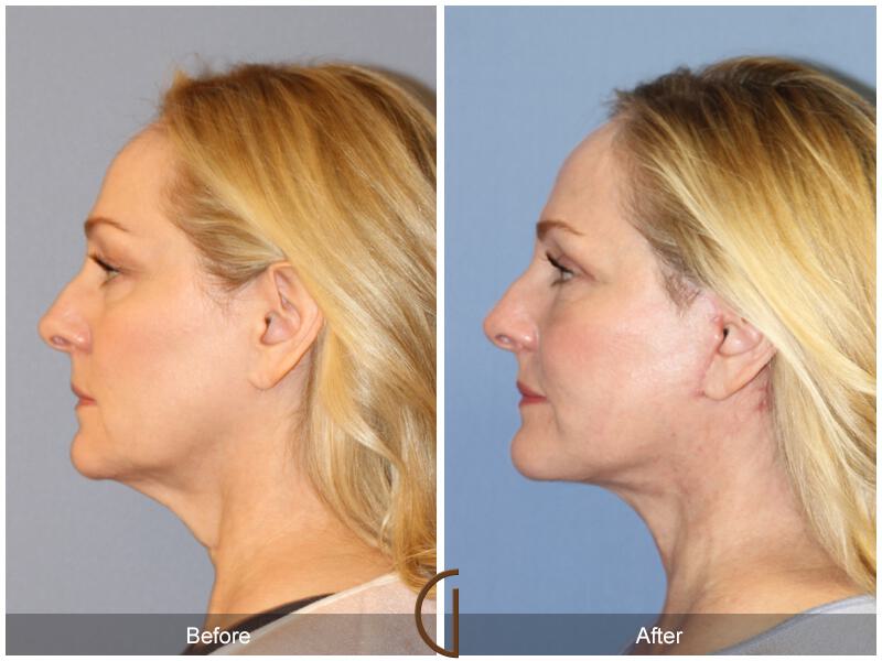 Facelift Forties Before & After Photo