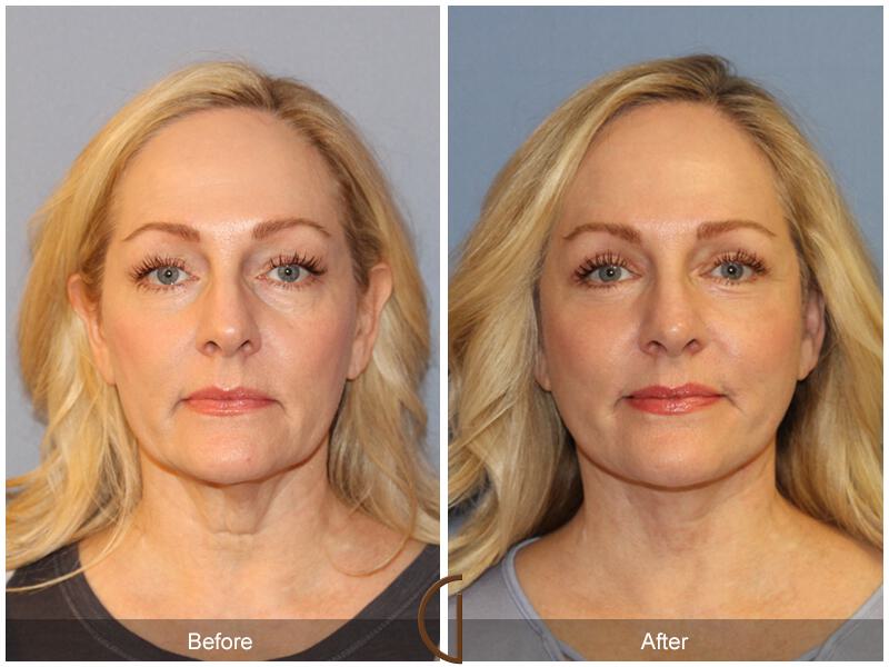 Facelift Forties Before & After Photo