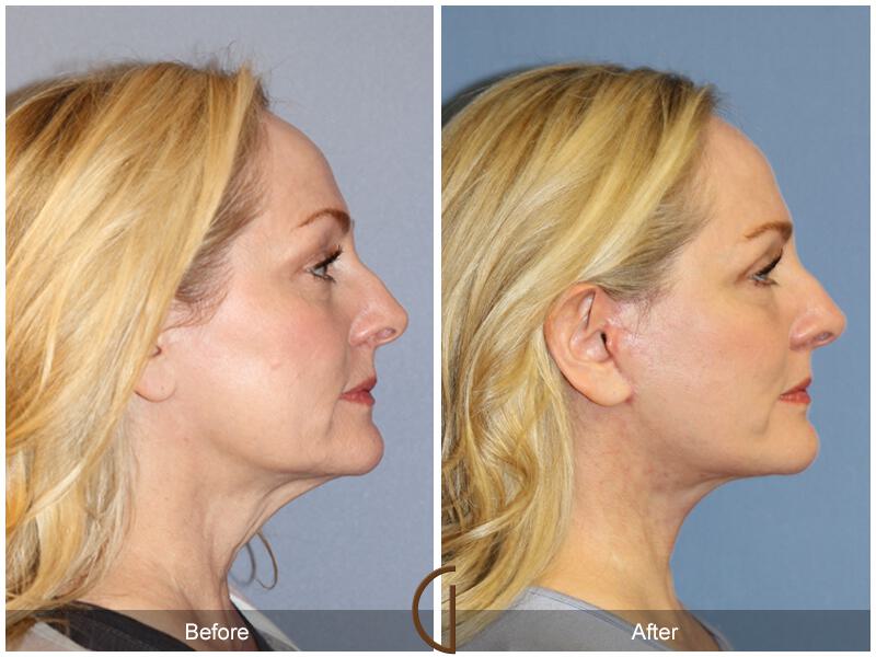 Facelift Forties Before & After Photo