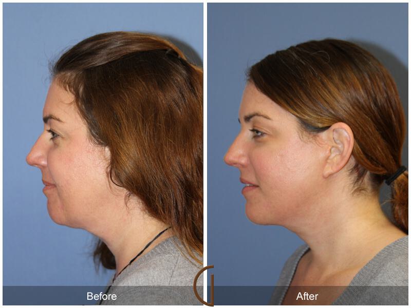 Facelift Forties Before & After Photo