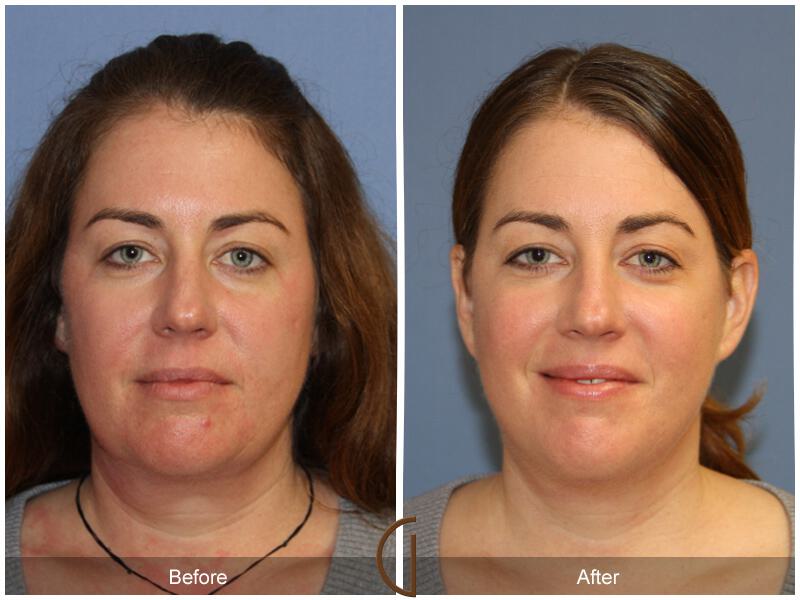 Facelift Forties Before & After Photo