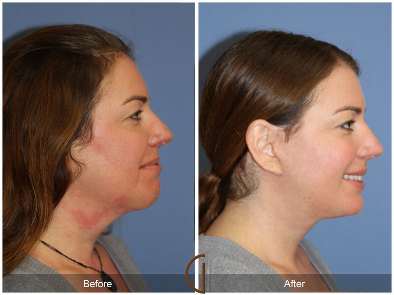 Facelift Forties Before & After Photo