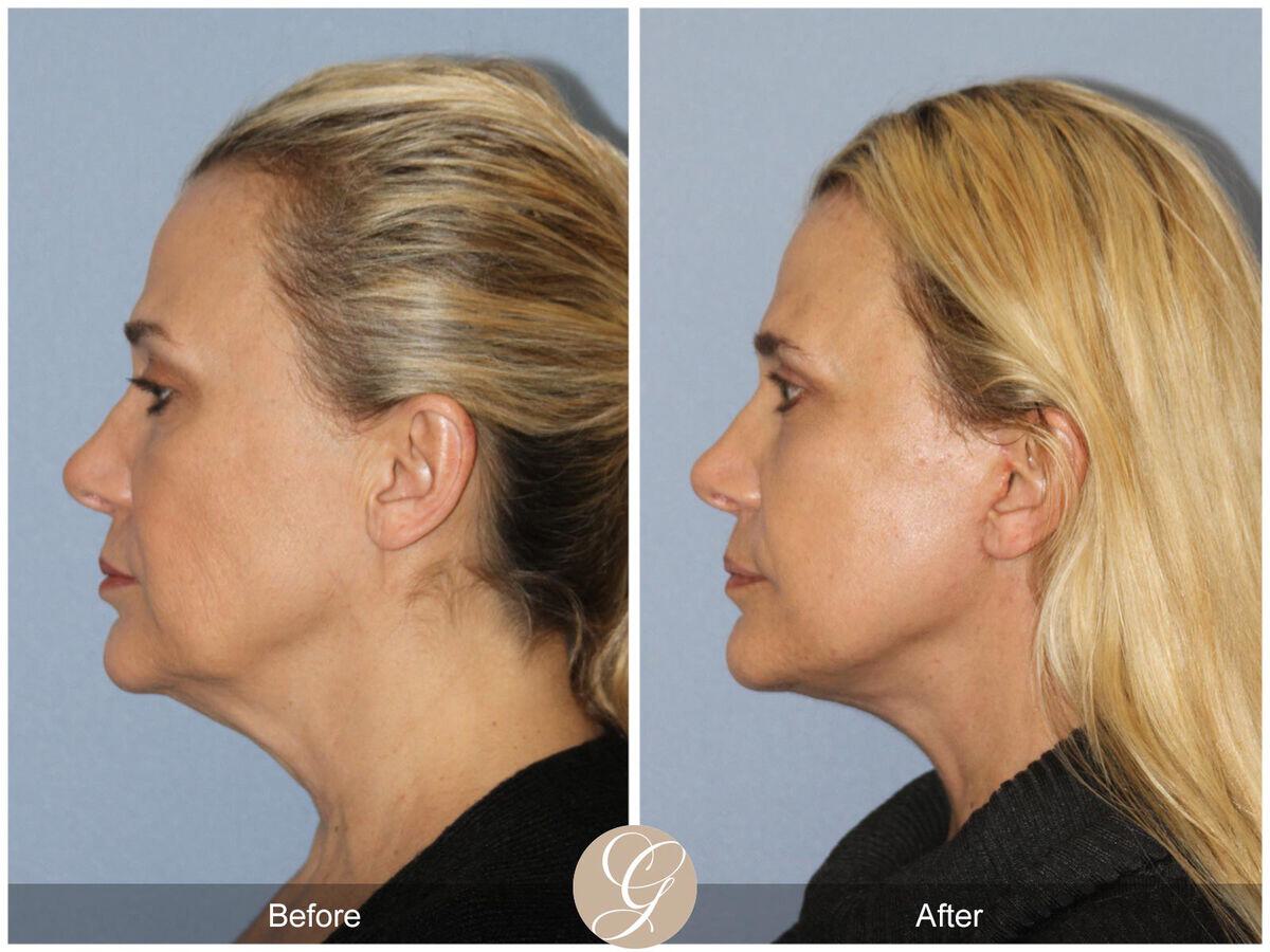 Facelift Forties Before & After Photo