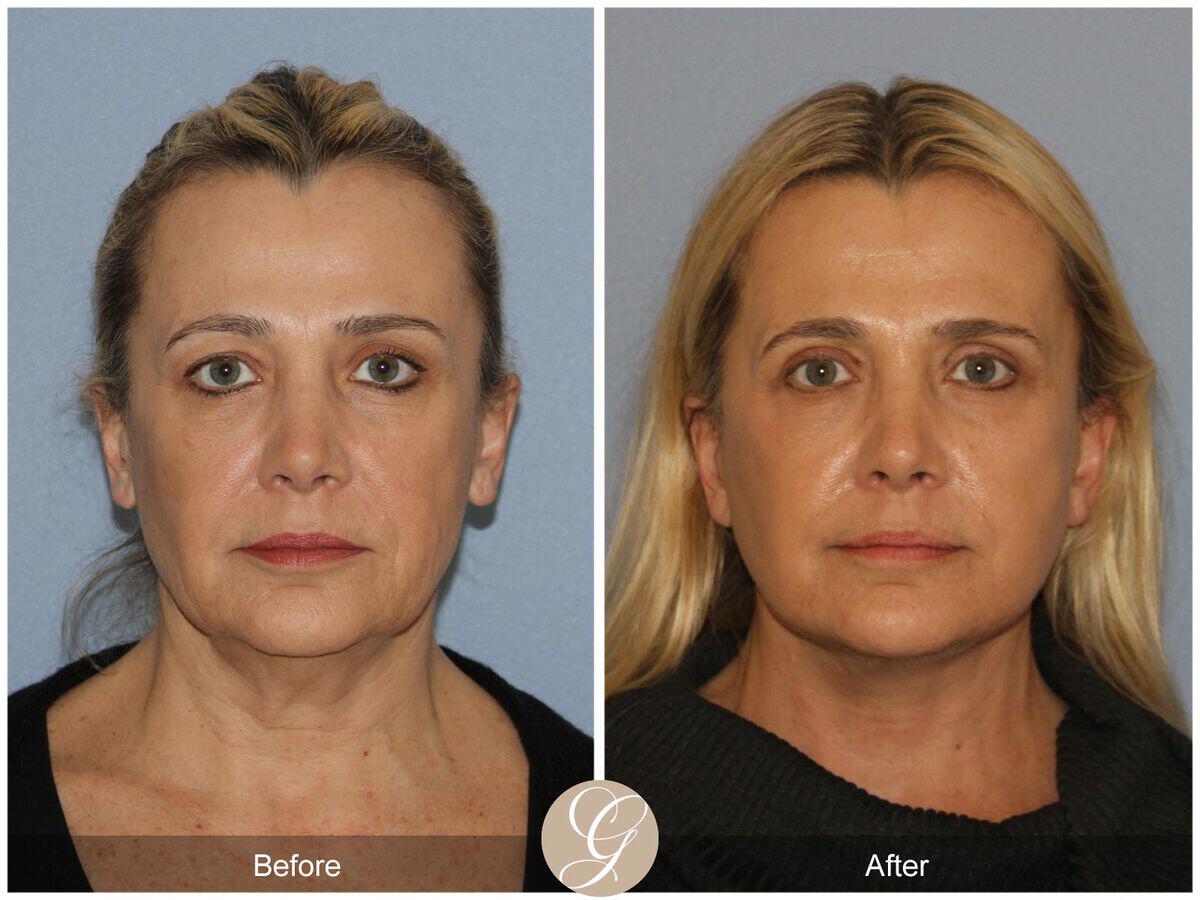 Facelift Forties Before & After Photo