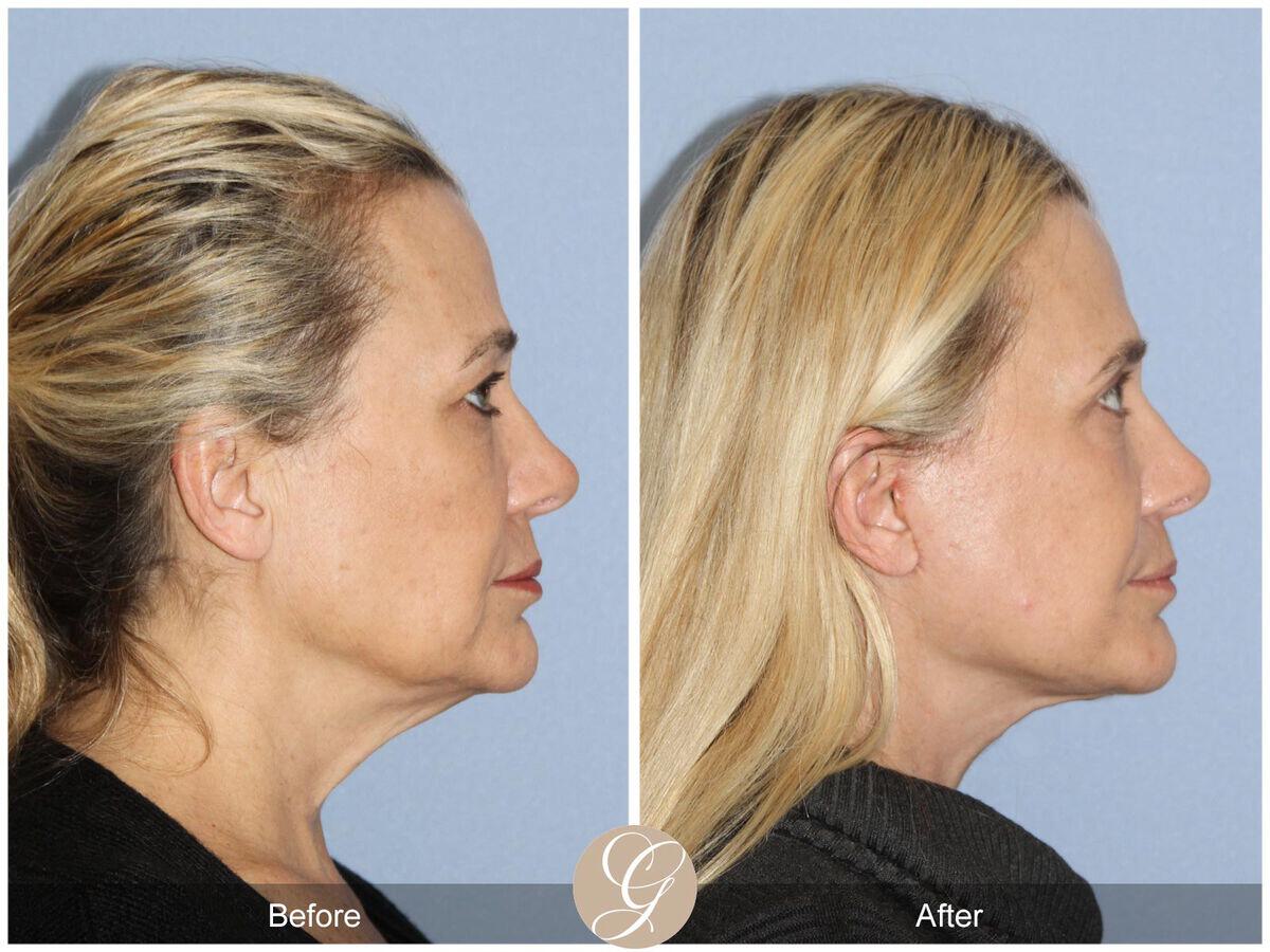 Facelift Forties Before & After Photo