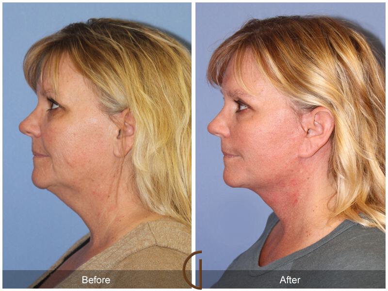 Facelift Forties Before & After Photo