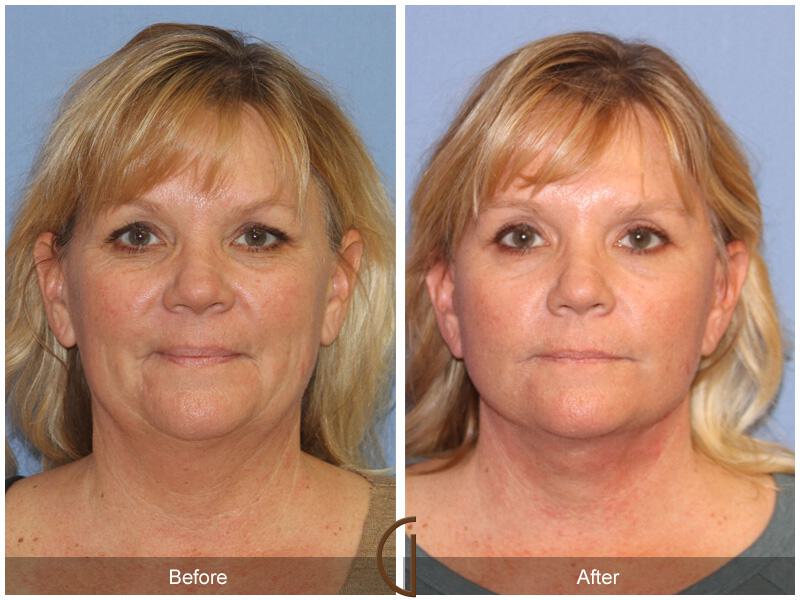 Facelift Forties Before & After Photo