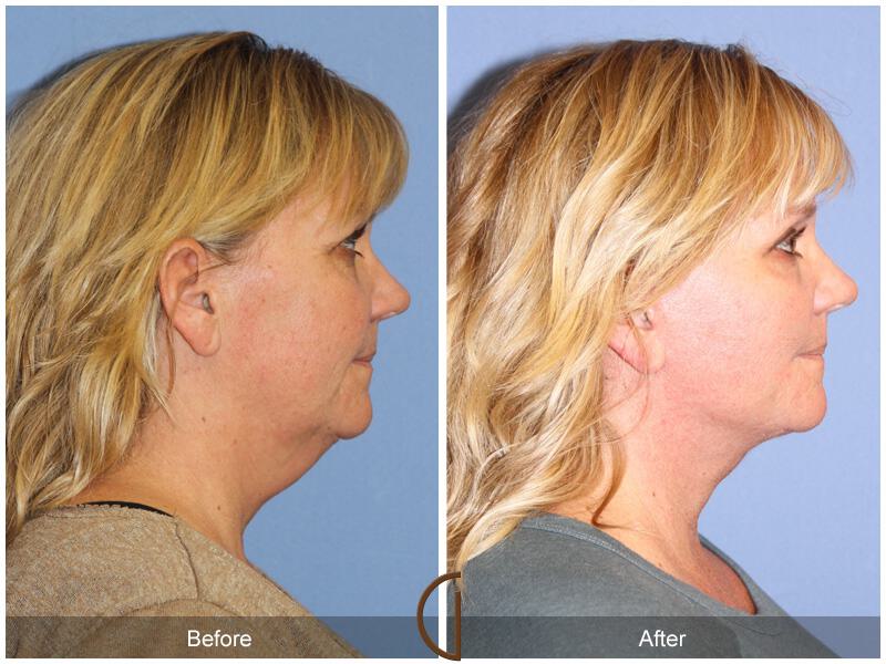 Facelift Forties Before & After Photo