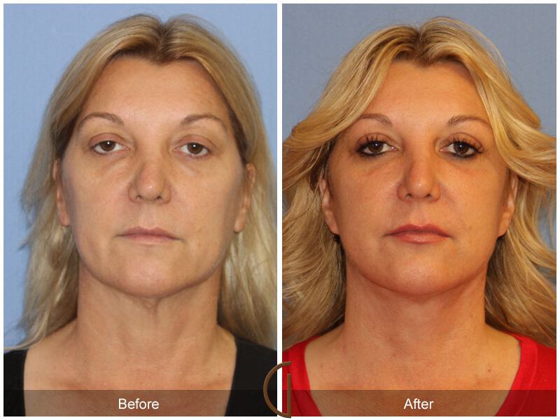 Facelift Forties Before & After Photo