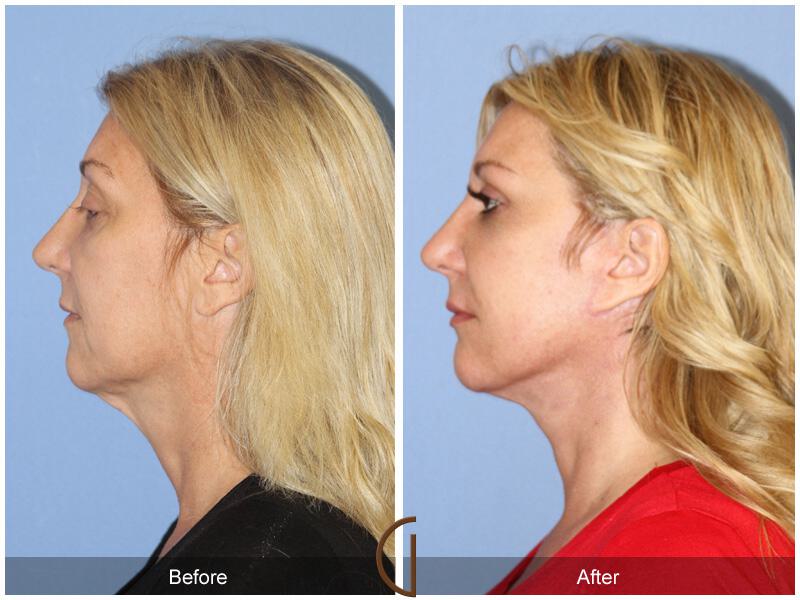 Facelift Forties Before & After Photo