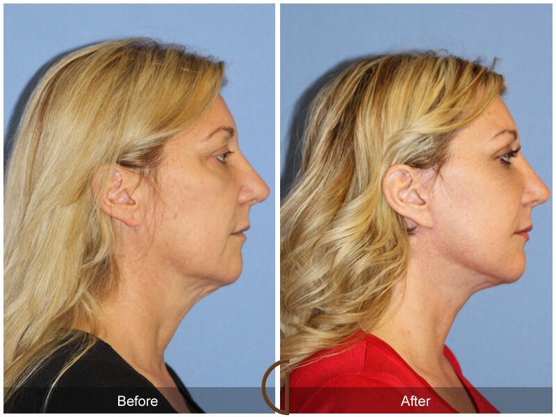 Facelift Forties Before & After Photo