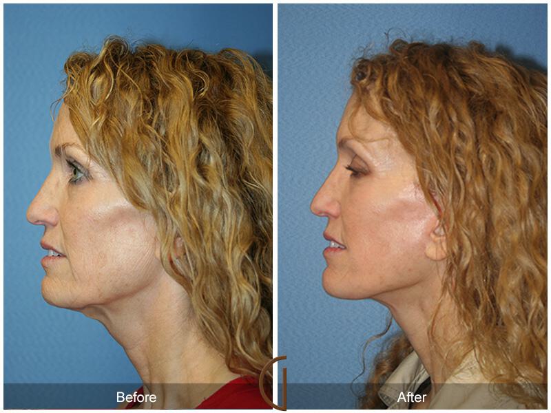 Facelift Forties Before & After Photo