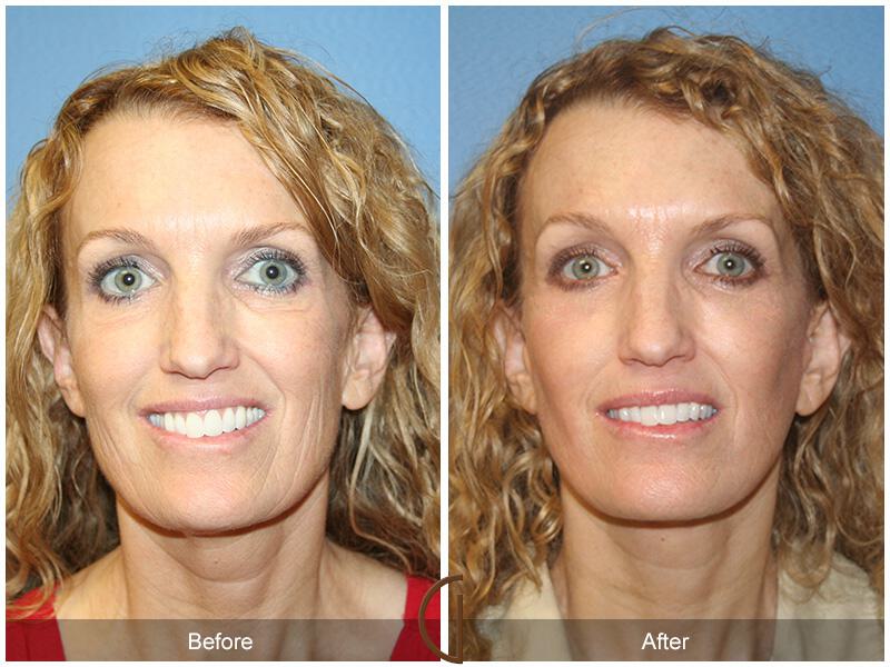 Facelift Forties Before & After Photo