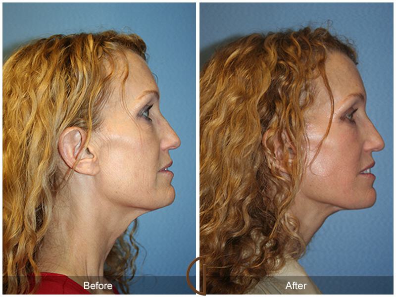 Facelift Forties Before & After Photo