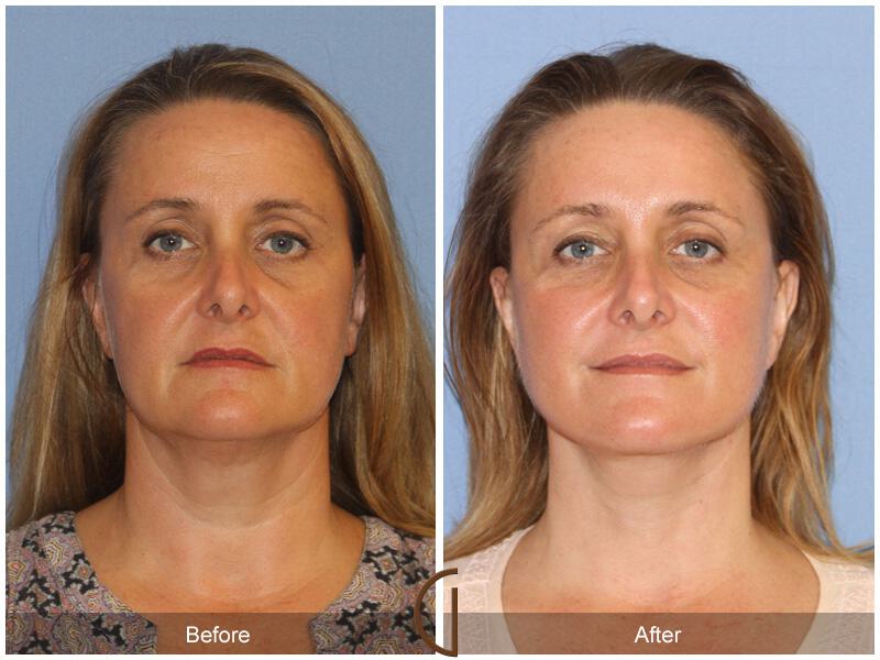 Facelift Forties Before & After Photo