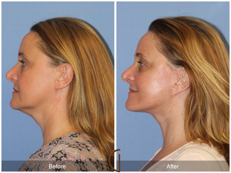 Facelift Forties Before & After Photo