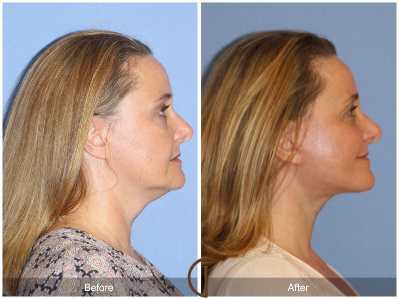 Facelift Forties Before & After Photo