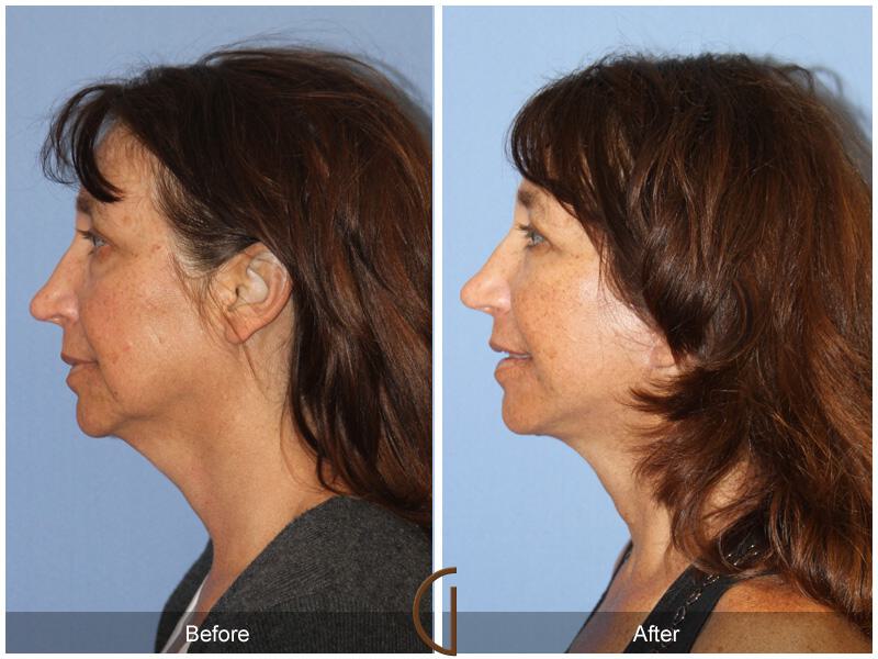 Facelift Forties Before & After Photo