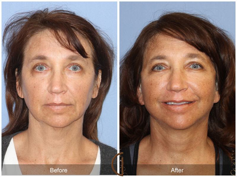 Facelift Forties Before & After Photo