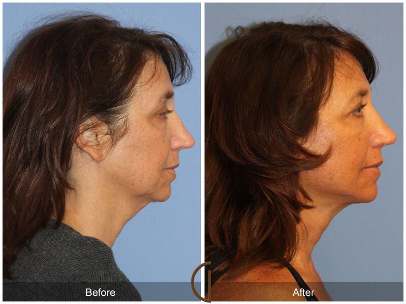 Facelift Forties Before & After Photo