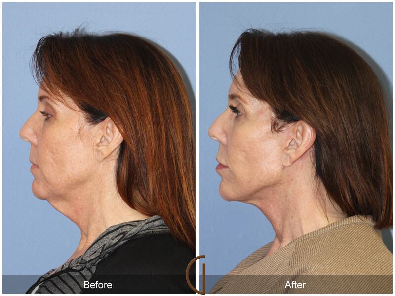 Facelift Forties Before & After Photo