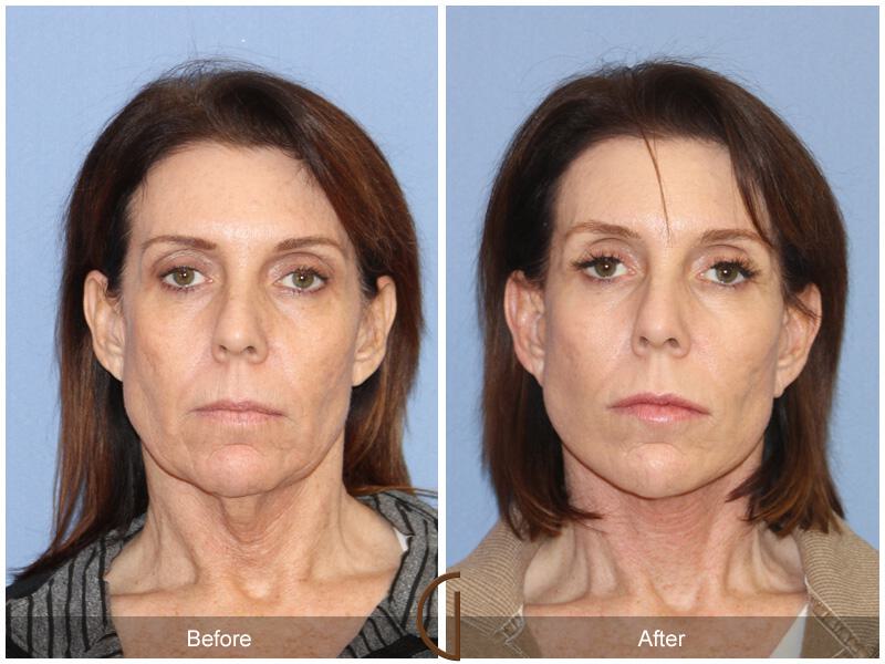 Facelift Forties Before & After Photo