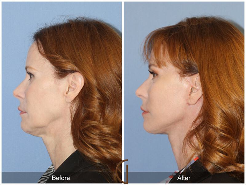 Facelift Forties Before & After Photo