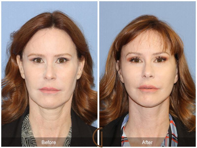 Facelift Forties Before & After Photo