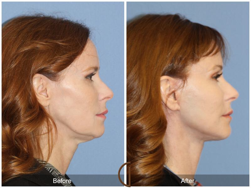 Facelift Forties Before & After Photo