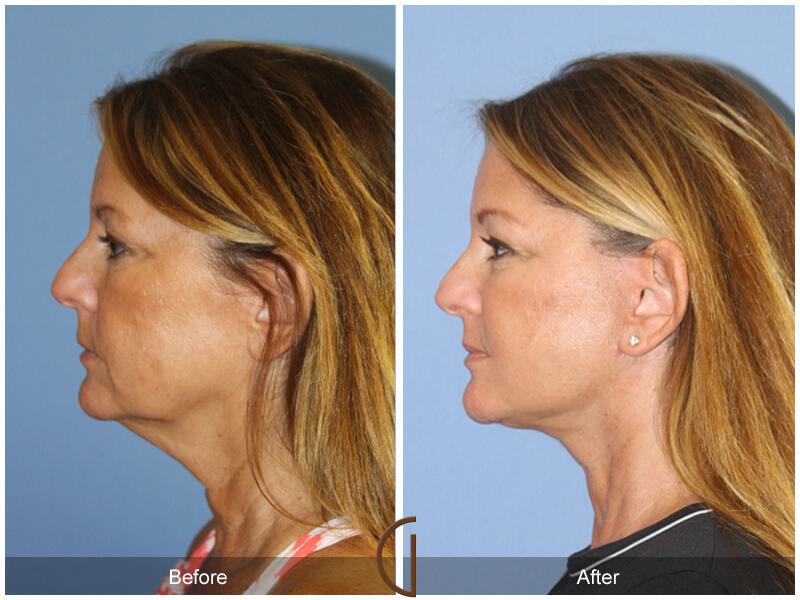 Facelift Forties Before & After Photo