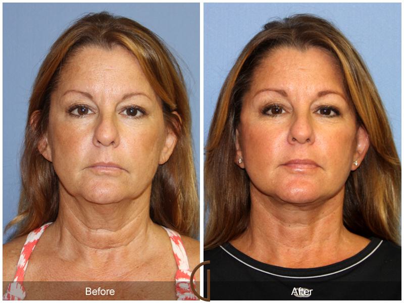 Facelift Forties Before & After Photo