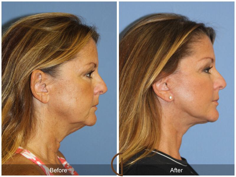 Facelift Forties Before & After Photo