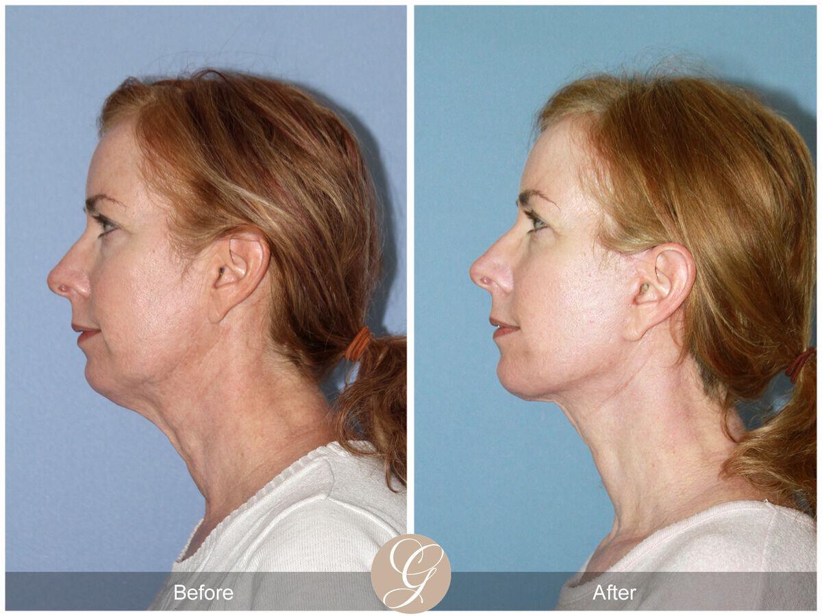 Facelift Forties Before & After Photo