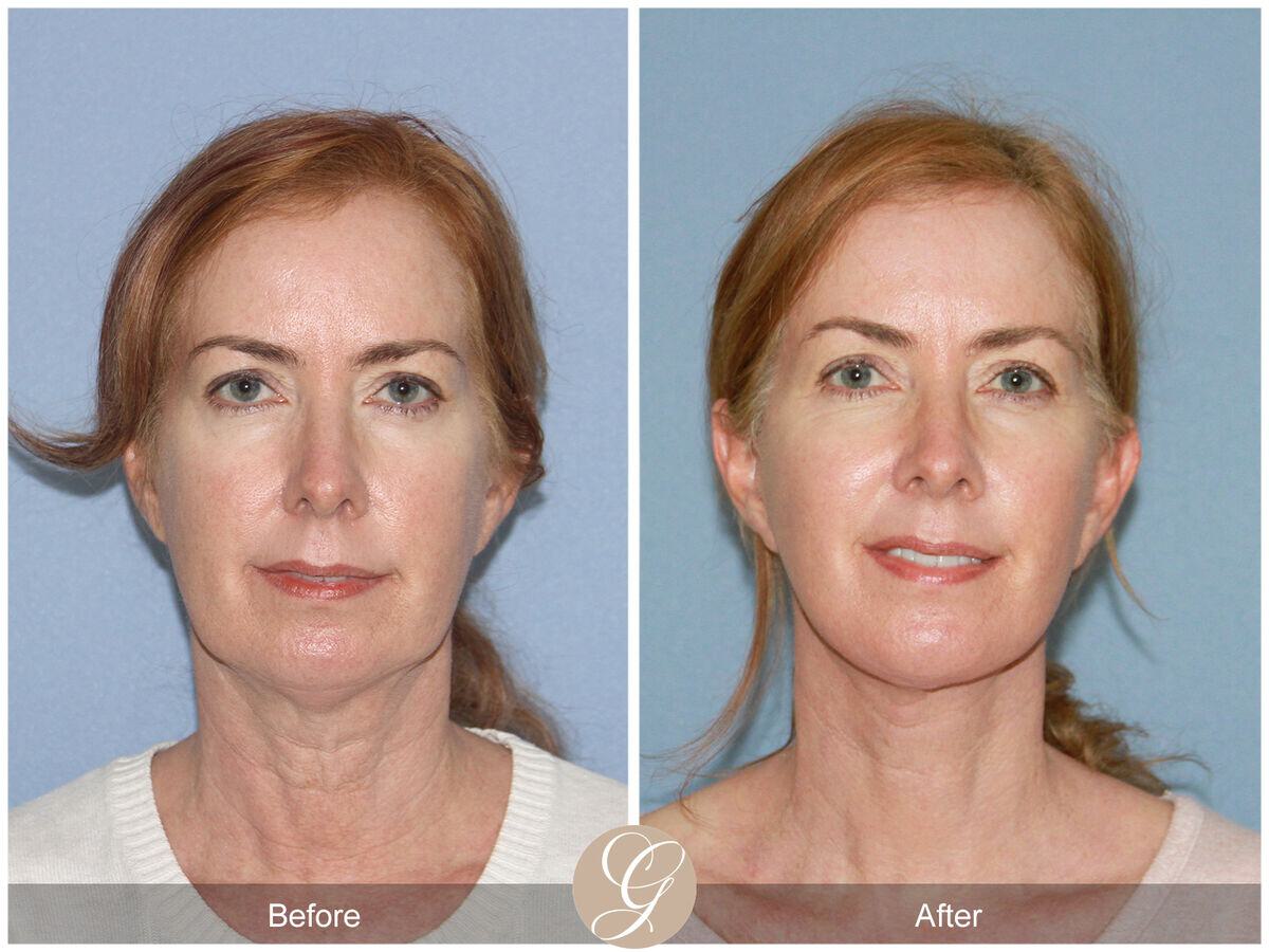 Facelift Forties Before & After Photo